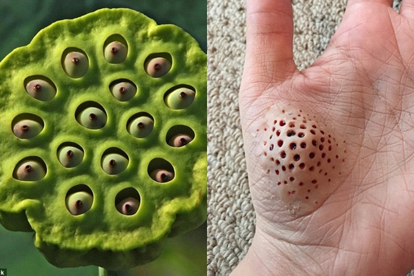 Chứng sợ lỗ - Hình ảnh minh họa